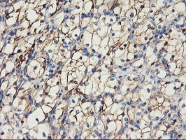 CDH2 / N Cadherin Antibody - IHC of paraffin-embedded Carcinoma of Human kidney tissue using anti-CDH2 mouse monoclonal antibody.