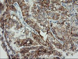 CDH2 / N Cadherin Antibody - IHC of paraffin-embedded Adenocarcinoma of Human ovary tissue using anti-CDH2 mouse monoclonal antibody.