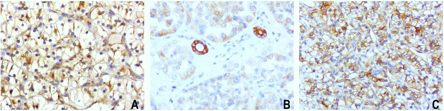 CDH2 / N Cadherin Antibody - Immunohistochemical staining of paraffin-embedded of 3 human carcinoma of kidney using anti-CDH2 clone UMAB23 mouse monoclonal antibody at 1:400 dilution of 1.0mg/mL using Polink2 Broad HRP DAB detection kit.requires heat-induced epitope retrieval with Citrate pH6.0 in a pressure chamber/cooker high 3min. The composit image of 3 human carcinoma of the kidney all show strong membraneous and cytoplasmic staining in the tumor cells.