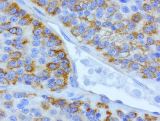CDH2 / N Cadherin Antibody - Immunohistochemical staining of paraffin-embedded of human carcinoma of the lung using anti-CDH2 clone UMAB23 mouse monoclonal antibody at 1:400 dilution of 1.0mg/mL using Polink2 Broad HRP DAB detection kit.requires heat-induced epitope retrieval with Citrate pH6.0 in a pressure chamber/cooker high 3min. The image shows the tumor cells with membraneous and cytoplasmic staining.