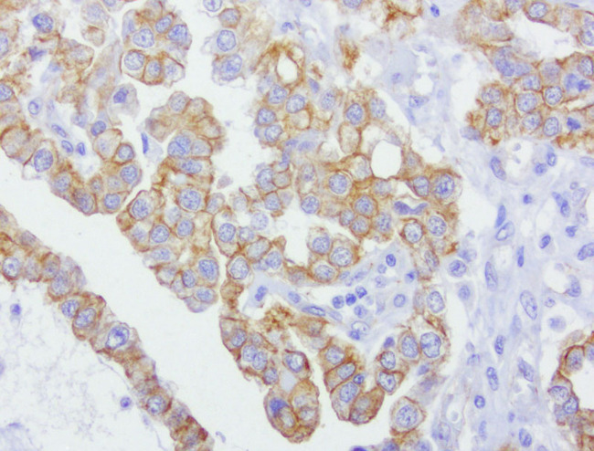 CDH2 / N Cadherin Antibody - Immunohistochemical staining of paraffin-embedded of human ovarian carcinoma using anti-CDH2 clone UMAB23 mouse monoclonal antibody at 1:400 dilution of 1.0mg/mL using Polink2 Broad HRP DAB detection kit.requires heat-induced epitope retrieval with Citrate pH6.0 in a pressure chamber/cooker high 3min. The image shows strong membranous and cytoplsamic staining of the tumor cells