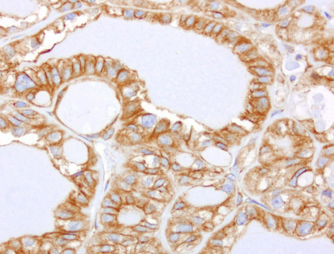 CDH2 / N Cadherin Antibody - Immunohistochemical staining of paraffin-embedded of human thyroid carcinoma using anti-CDH2 clone UMAB23 mouse monoclonal antibody at 1:400 dilution of 1.0mg/mL using Polink2 Broad HRP DAB detection kit.requires heat-induced epitope retrieval with Citrate pH6.0 in a pressure chamber/cooker high 3min. The image shows strong membranous and cytoplsamic staining of the tumor cells