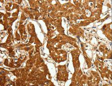 CDH23 / Cadherin 23 Antibody - Immunohistochemistry of paraffin-embedded Human lung cancer using CDH23 Polyclonal Antibody at dilution of 1:80.