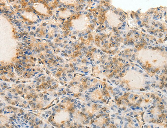CDH23 / Cadherin 23 Antibody - Immunohistochemistry of paraffin-embedded Human thyroid cancer using CDH23 Polyclonal Antibody at dilution of 1:60.