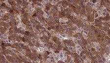 CDH23 / Cadherin 23 Antibody - 1:100 staining human liver carcinoma tissues by IHC-P. The sample was formaldehyde fixed and a heat mediated antigen retrieval step in citrate buffer was performed. The sample was then blocked and incubated with the antibody for 1.5 hours at 22°C. An HRP conjugated goat anti-rabbit antibody was used as the secondary.