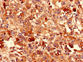 CDH3 / P-Cadherin Antibody - Immunocytochemistry analysis of human melanoma using CDH3 Antibody at dilution of 1:100