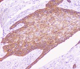 CDH3 / P-Cadherin Antibody - IHC analysis of P cadherin using anti-P cadherin antibody. P cadherin was detected in paraffin-embedded section of human oesophagus squama cancer tissue. Heat mediated antigen retrieval was performed in citrate buffer (pH6, epitope retrieval solution) for 20 mins. The tissue section was blocked with 10% goat serum. The tissue section was then incubated with 1µg/ml rabbit anti-P cadherin Antibody overnight at 4°C. Biotinylated goat anti-rabbit IgG was used as secondary antibody and incubated for 30 minutes at 37°C. The tissue section was developed using Strepavidin-Biotin-Complex (SABC) with DAB as the chromogen.