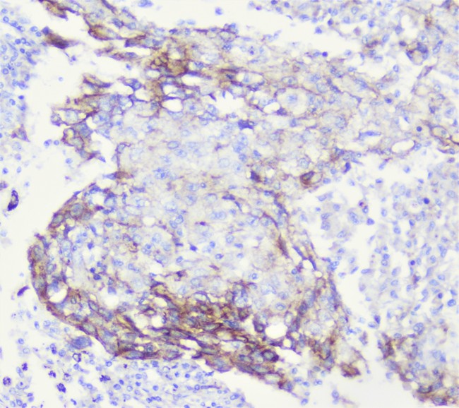 CDH3 / P-Cadherin Antibody - IHC analysis of P cadherin using anti-P cadherin antibody. P cadherin was detected in paraffin-embedded section of human lung cancer tissue. Heat mediated antigen retrieval was performed in citrate buffer (pH6, epitope retrieval solution) for 20 mins. The tissue section was blocked with 10% goat serum. The tissue section was then incubated with 1µg/ml rabbit anti-P cadherin Antibody overnight at 4°C. Biotinylated goat anti-rabbit IgG was used as secondary antibody and incubated for 30 minutes at 37°C. The tissue section was developed using Strepavidin-Biotin-Complex (SABC) with DAB as the chromogen.