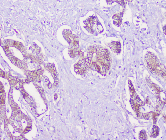 CDH3 / P-Cadherin Antibody - IHC analysis of P cadherin using anti-P cadherin antibody. P cadherin was detected in paraffin-embedded section of human cholangiocarcinoma tissue. Heat mediated antigen retrieval was performed in citrate buffer (pH6, epitope retrieval solution) for 20 mins. The tissue section was blocked with 10% goat serum. The tissue section was then incubated with 1µg/ml rabbit anti-P cadherin Antibody overnight at 4°C. Biotinylated goat anti-rabbit IgG was used as secondary antibody and incubated for 30 minutes at 37°C. The tissue section was developed using Strepavidin-Biotin-Complex (SABC) with DAB as the chromogen.