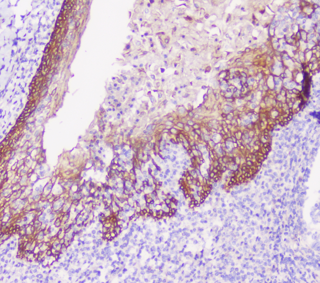 CDH3 / P-Cadherin Antibody - IHC analysis of P cadherin using anti-P cadherin antibody. P cadherin was detected in paraffin-embedded section of human tonsil tissue. Heat mediated antigen retrieval was performed in citrate buffer (pH6, epitope retrieval solution) for 20 mins. The tissue section was blocked with 10% goat serum. The tissue section was then incubated with 1µg/ml rabbit anti-P cadherin Antibody overnight at 4°C. Biotinylated goat anti-rabbit IgG was used as secondary antibody and incubated for 30 minutes at 37°C. The tissue section was developed using Strepavidin-Biotin-Complex (SABC) with DAB as the chromogen.