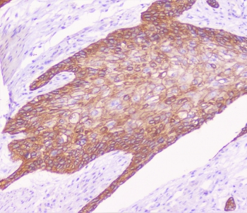 CDH3 / P-Cadherin Antibody - IHC staining of FFPE human esophagus squama cancer with CDH3 antibody at 1ug/ml. HIER: boil tissue sections in pH6, 10mM citrate buffer, for 10-20 min followed by cooling at RT for 20 min.