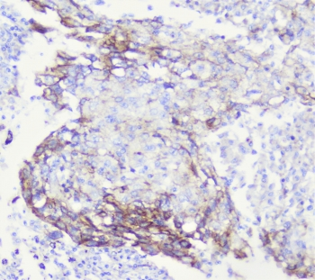 CDH3 / P-Cadherin Antibody - IHC staining of FFPE human lung cancer with CDH3 antibody at 1ug/ml. HIER: boil tissue sections in pH6, 10mM citrate buffer, for 10-20 min followed by cooling at RT for 20 min.