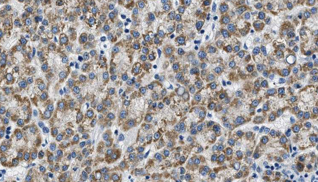 CDH3 / P-Cadherin Antibody - 1:100 staining human liver carcinoma tissues by IHC-P. The sample was formaldehyde fixed and a heat mediated antigen retrieval step in citrate buffer was performed. The sample was then blocked and incubated with the antibody for 1.5 hours at 22°C. An HRP conjugated goat anti-rabbit antibody was used as the secondary.