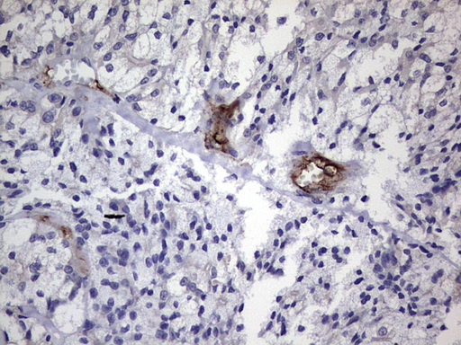 CDH4 / R Cadherin Antibody - Immunohistochemical staining of paraffin-embedded Carcinoma of Human thyroid tissue using anti-CDH4 mouse monoclonal antibody. (Heat-induced epitope retrieval by 1 mM EDTA in 10mM Tris, pH8.5, 120C for 3min,