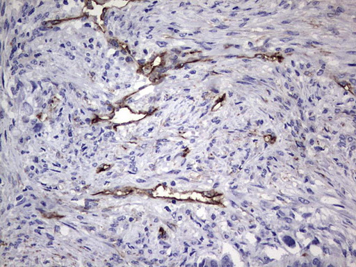 CDH4 / R Cadherin Antibody - Immunohistochemical staining of paraffin-embedded Carcinoma of Human kidney tissue using anti-CDH4 mouse monoclonal antibody. (Heat-induced epitope retrieval by 1 mM EDTA in 10mM Tris, pH8.5, 120C for 3min,