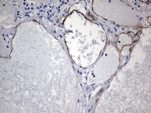 CDH4 / R Cadherin Antibody - Immunohistochemical staining of paraffin-embedded Human thyroid tissue within the normal limits using anti-CDH4 mouse monoclonal antibody. (Heat-induced epitope retrieval by 1 mM EDTA in 10mM Tris, pH8.5, 120C for 3min,