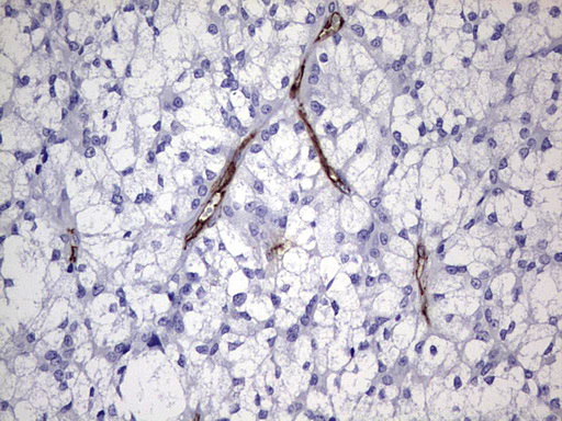 CDH4 / R Cadherin Antibody - Immunohistochemical staining of paraffin-embedded Carcinoma of Human thyroid tissue using anti-CDH4 mouse monoclonal antibody. (Heat-induced epitope retrieval by 1 mM EDTA in 10mM Tris, pH8.5, 120C for 3min,