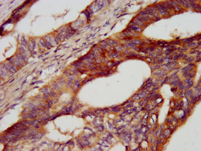 CDH7 / Cadherin 7 Antibody - Immunohistochemistry image at a dilution of 1:400 and staining in paraffin-embedded human colon cancer performed on a Leica BondTM system. After dewaxing and hydration, antigen retrieval was mediated by high pressure in a citrate buffer (pH 6.0) . Section was blocked with 10% normal goat serum 30min at RT. Then primary antibody (1% BSA) was incubated at 4 °C overnight. The primary is detected by a biotinylated secondary antibody and visualized using an HRP conjugated SP system.
