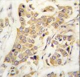 CDH8 / Cadherin 8 Antibody - Formalin-fixed and paraffin-embedded human breast carcinoma tissue reacted with CDH8 antibody , which was peroxidase-conjugated to the secondary antibody, followed by DAB staining. This data demonstrates the use of this antibody for immunohistochemistry; clinical relevance has not been evaluated.