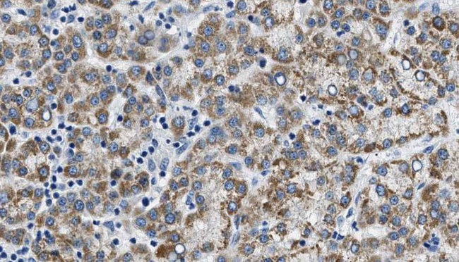 CDH8 / Cadherin 8 Antibody - 1:100 staining human liver carcinoma tissues by IHC-P. The sample was formaldehyde fixed and a heat mediated antigen retrieval step in citrate buffer was performed. The sample was then blocked and incubated with the antibody for 1.5 hours at 22°C. An HRP conjugated goat anti-rabbit antibody was used as the secondary.