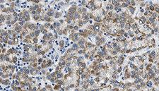 CDH8 / Cadherin 8 Antibody - 1:100 staining human liver carcinoma tissues by IHC-P. The sample was formaldehyde fixed and a heat mediated antigen retrieval step in citrate buffer was performed. The sample was then blocked and incubated with the antibody for 1.5 hours at 22°C. An HRP conjugated goat anti-rabbit antibody was used as the secondary.