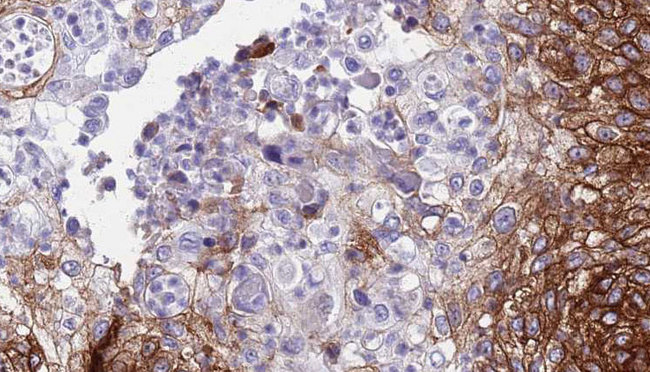 CDH9 / Cadherin 9 Antibody - 1:100 staining human urothelial carcinoma tissue by IHC-P. The sample was formaldehyde fixed and a heat mediated antigen retrieval step in citrate buffer was performed. The sample was then blocked and incubated with the antibody for 1.5 hours at 22°C. An HRP conjugated goat anti-rabbit antibody was used as the secondary.