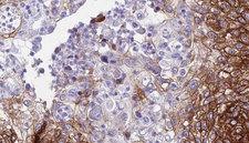 CDH9 / Cadherin 9 Antibody - 1:100 staining human urothelial carcinoma tissue by IHC-P. The sample was formaldehyde fixed and a heat mediated antigen retrieval step in citrate buffer was performed. The sample was then blocked and incubated with the antibody for 1.5 hours at 22°C. An HRP conjugated goat anti-rabbit antibody was used as the secondary.