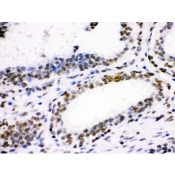 CDK1 / CDC2 Antibody - CDK1 antibody IHC-paraffin. IHC(P): Human Mammary Cancer Tissue.
