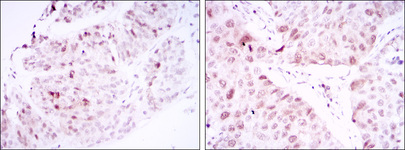 CDK1 / CDC2 Antibody - IHC of paraffin-embedded ovarian cancer tissues (left) and lung cancer tissues (right) using CDK1 mouse monoclonal antibody with DAB staining.