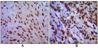 CDK1 / CDC2 Antibody - IHC of paraffin-embedded human lung cancer (A) and esophageal cancer (B), showing cytoplasmic localization using CDC2 mouse monoclonal antibody with DAB staining.