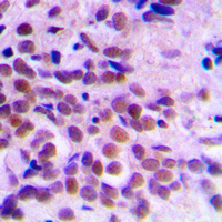 CDK1 / CDC2 Antibody - Immunohistochemical analysis of CDC2 staining in human breast cancer formalin fixed paraffin embedded tissue section. The section was pre-treated using heat mediated antigen retrieval with sodium citrate buffer (pH 6.0). The section was then incubated with the antibody at room temperature and detected using an HRP conjugated compact polymer system. DAB was used as the chromogen. The section was then counterstained with hematoxylin and mounted with DPX.