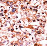 CDK1 / CDC2 Antibody - Formalin-fixed and paraffin-embedded human cancer tissue reacted with the primary antibody, which was peroxidase-conjugated to the secondary antibody, followed by AEC staining. This data demonstrates the use of this antibody for immunohistochemistry; clinical relevance has not been evaluated. BC = breast carcinoma; HC = hepatocarcinoma.
