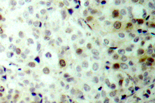 CDK1 / CDC2 Antibody - IHC of p-CDC2 (T161) pAb in paraffin-embedded human breast carcinoma tissue.