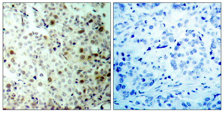 CDK1 / CDC2 Antibody - Immunohistochemistry analysis of paraffin-embedded human breast carcinoma, using CDC2 (Phospho-Thr161) Antibody. The picture on the right is blocked with the phospho peptide.
