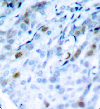 CDK1 / CDC2 Antibody - Immunohistochemical analysis of paraffin-embedded human breast carcinoma tissue.