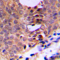 CDK1 / CDC2 Antibody - Immunohistochemical analysis of CDC2 (pT161) staining in human breast cancer formalin fixed paraffin embedded tissue section. The section was pre-treated using heat mediated antigen retrieval with sodium citrate buffer (pH 6.0). The section was then incubated with the antibody at room temperature and detected using an HRP conjugated compact polymer system. DAB was used as the chromogen. The section was then counterstained with hematoxylin and mounted with DPX.