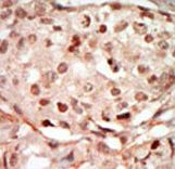 CDK10 Antibody - Formalin-fixed and paraffin-embedded human cancer tissue reacted with the primary antibody, which was peroxidase-conjugated to the secondary antibody, followed by DAB staining. This data demonstrates the use of this antibody for immunohistochemistry; clinical relevance has not been evaluated. BC = breast carcinoma; HC = hepatocarcinoma.