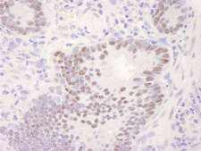 CDK11A / CDC2L2 Antibody - Detection of Human CDK11 by Immunohistochemistry. Sample: FFPE section of human stomach adenocarcinoma. Antibody: Affinity purified rabbit anti-CDK11 used at a dilution of 1:250. Detection: DAB.