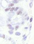 CDK11A / CDC2L2 Antibody - Detection of Human CDK11 by Immunohistochemistry. Sample: FFPE section of human stomach carcinoma. Antibody: Affinity purified rabbit anti-CDK11 used at a dilution of 1:1000 (1 ug/ml).