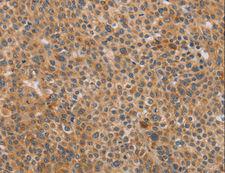 CDK11B / CDC2L1 Antibody - Immunohistochemistry of paraffin-embedded Human liver cancer using CDK11A/CDK11B Polyclonal Antibody at dilution of 1:40.