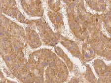 CDK11B / CDC2L1 Antibody - Immunochemical staining of human CDK11B in human hepatoma with rabbit polyclonal antibody at 1:300 dilution, formalin-fixed paraffin embedded sections.