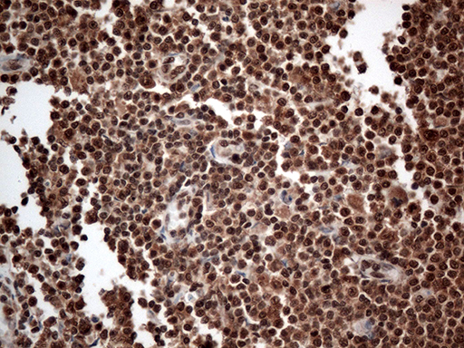 CDK15 / ALS2CR7 Antibody - Immunohistochemical staining of paraffin-embedded Human lymphoma tissue using anti-CDK15 mouse monoclonal antibody. (Heat-induced epitope retrieval by 1mM EDTA in 10mM Tris buffer. (pH8.5) at 120°C for 3 min. (1:500)
