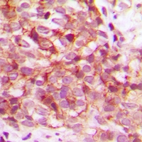 CDK15 / ALS2CR7 Antibody - Immunohistochemical analysis of CDK15 staining in human breast cancer formalin fixed paraffin embedded tissue section. The section was pre-treated using heat mediated antigen retrieval with sodium citrate buffer (pH 6.0). The section was then incubated with the antibody at room temperature and detected with HRP and DAB as chromogen. The section was then counterstained with hematoxylin and mounted with DPX.