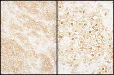 CDK17 / PCTK2 / PCTAIRE2 Antibody - Detection of Human PCTAIRE 2 by Immunohistochemistry. Sample: FFPE section of human breast carcinoma (left) and kidney clear cell carcinoma (right). Antibody: Affinity purified rabbit anti-PCTAIRE 2 used at a dilution of 1:1000 (1 ug/ml). Detection: DAB.