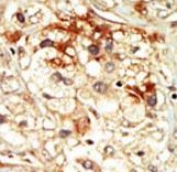 CDK17 / PCTK2 / PCTAIRE2 Antibody - Formalin-fixed and paraffin-embedded human cancer tissue reacted with the primary antibody, which was peroxidase-conjugated to the secondary antibody, followed by DAB staining. This data demonstrates the use of this antibody for immunohistochemistry; clinical relevance has not been evaluated. BC = breast carcinoma; HC = hepatocarcinoma.