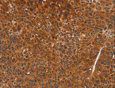 CDK19 / CDK11 Antibody - Immunohistochemistry of paraffin-embedded Human liver cancer using CDK19 Polyclonal Antibody at dilution of 1:70.
