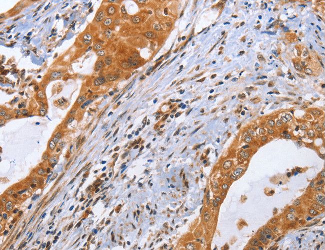 CDK19 / CDK11 Antibody - Immunohistochemistry of paraffin-embedded Human cervical cancer using CDK19 Polyclonal Antibody at dilution of 1:70.