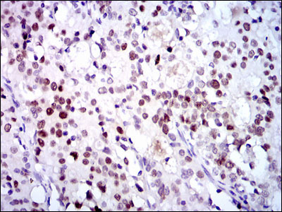CDK2 Antibody - IHC of paraffin-embedded cervical cancer tissues using CDK2 mouse monoclonal antibody with DAB staining.