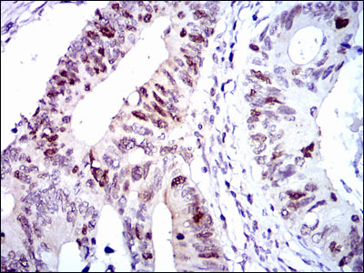 CDK2 Antibody - IHC of paraffin-embedded colon cancer tissues using CDK2 mouse monoclonal antibody with DAB staining.
