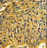 CDK2 Antibody - Formalin-fixed and paraffin-embedded human lung carcinoma reacted with CDK2 Antibody , which was peroxidase-conjugated to the secondary antibody, followed by DAB staining. This data demonstrates the use of this antibody for immunohistochemistry; clinical relevance has not been evaluated.